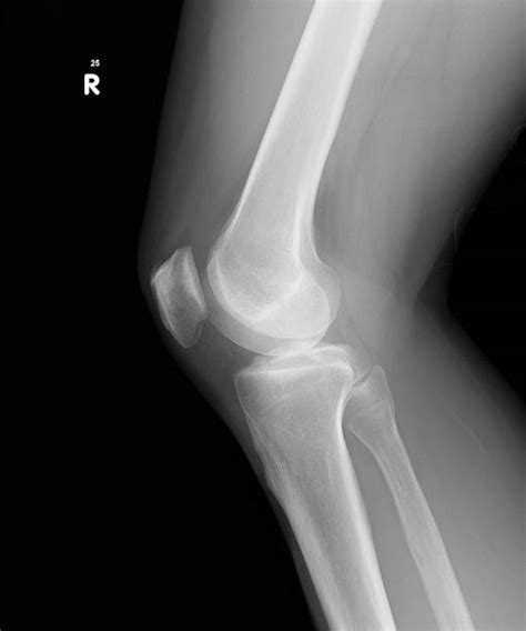 Lateral Knee Xray Stock Photos Pictures And Royalty Free Images Istock