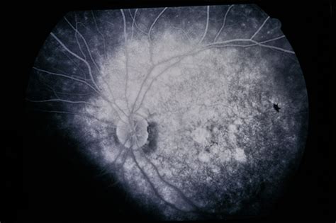 Stargardts Fundus Flavi Retina Image Bank