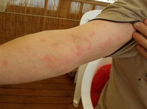 Red Itchy Bumps On Skin Causes Treatment Pictures
