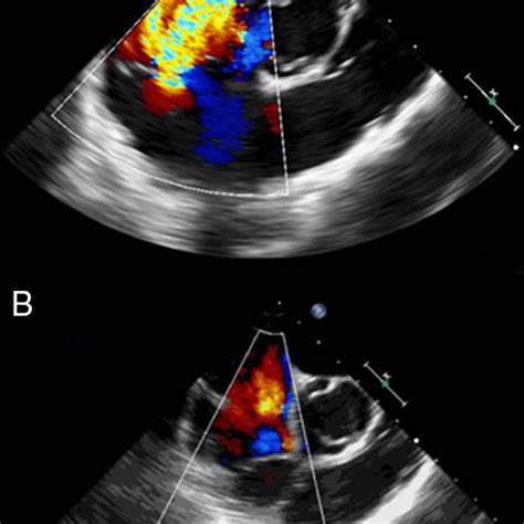 Mid Esophageal Right Ventricular Inflow Outflow View Before A With