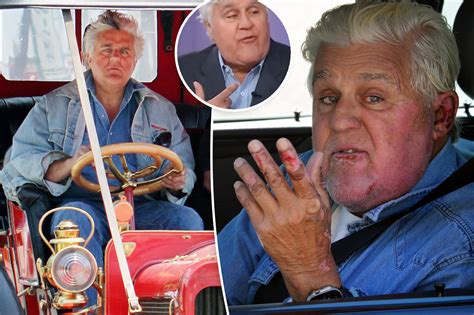 Jay Leno Reveals Unbelievable New Face Three Months After Car Fire