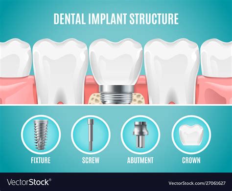 Dental Implant Structure Reallistic Tooth Vector Image