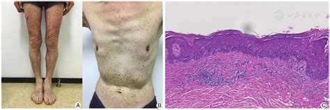 A Case Report Of Inflammatory Disseminated Superficial Porokeratosis