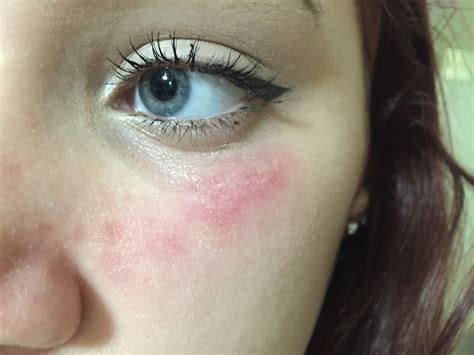 Allergic Reaction To Makeup Brushes Mugeek Vidalondon
