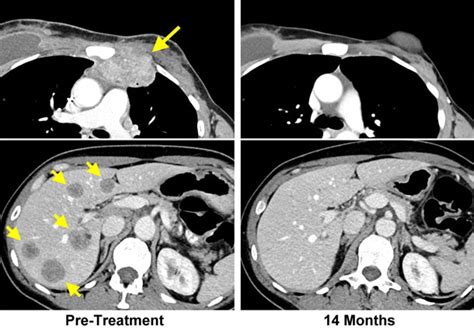 Ct scans can show a tumor's shape, size, and location. Immunotherapy targets metastatic breast cancer-cell ...