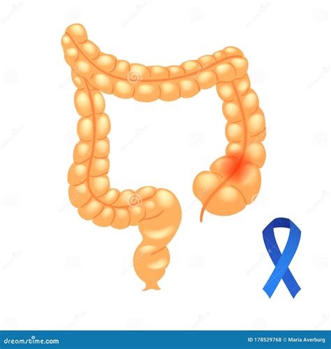 3d Illustration Of Colon Polyps Polyp In The Intestine Isolated White