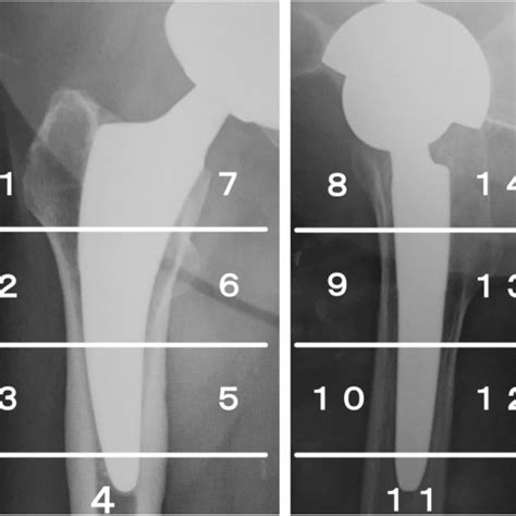 Gruen Zones In Anteroposterior And Lateral Radiograph According To