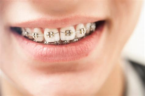 A Step By Step Process Of How Braces Work Henry Orthodontics Pinehurst North Carolina