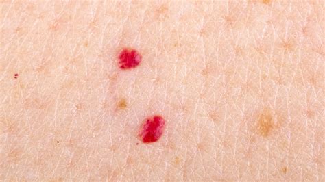 This Is Why You Have Red Marks On Your Skin And When You Should Get