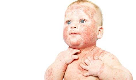 Hautausschlag Beim Baby Welche Erkrankung Steckt Dahinter