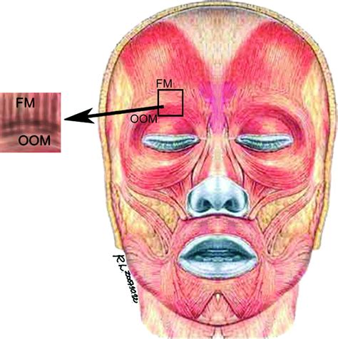 A New Trend For The Treatment Of Blepharoptosis Frontalis Orbicularis
