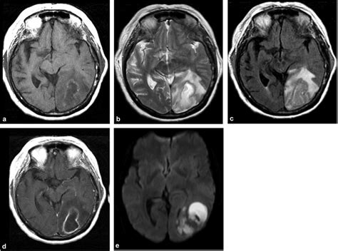 Typical Brain Abscess A Axial T1 Mr Image Mass With A Necrotic