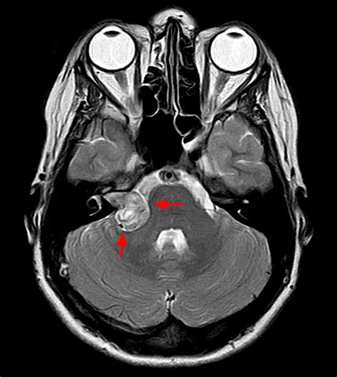 Acoustic Neuroma Causes Symptoms Diagnosis Treatment