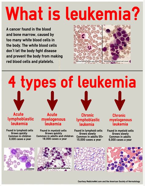 About Leukemia Things Health