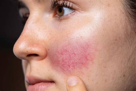 Find The Best Rosacea Treatment Plans Here