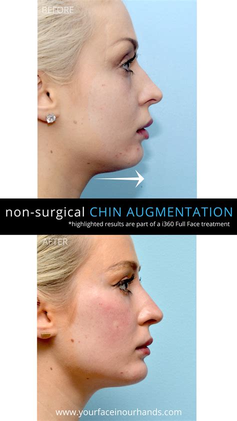 Before And After Results Of A Non Surgical Chin Augmentation With Dermal Fillers By Dr David