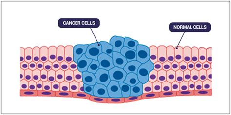 Cancer Types Causes Diagnosis And Treatment Of Cancer