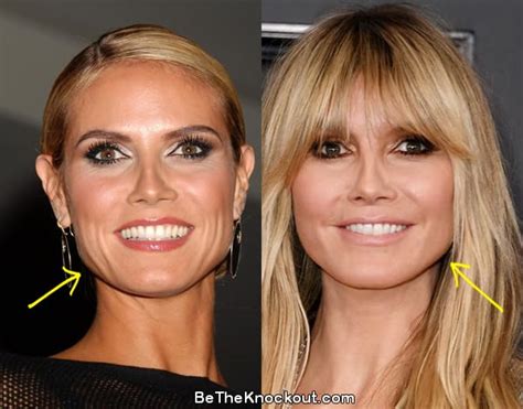 Heidi Klum Plastic Surgery Comparison Photos