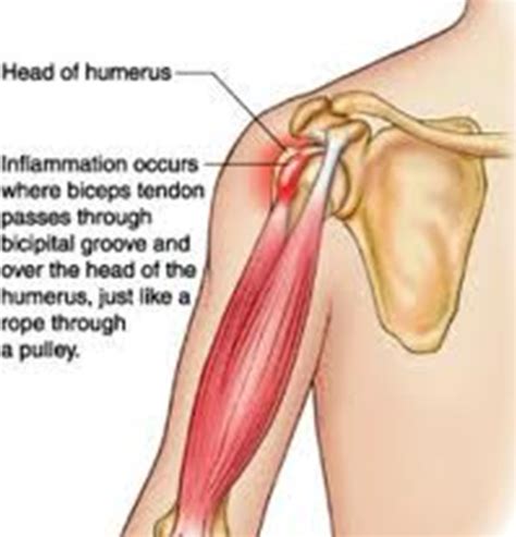 Upper Arm Muscles Pain