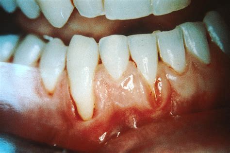 Facts About Gum Recession Canyon Gate Dental Of Orem