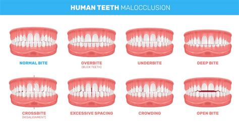 Types Of Malocclusion