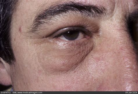 Stock Image Lower Eyelid Swelling Blepharochalasis In A Male Patient