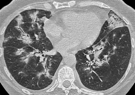 Diffuse Interstitial Pneumonia Lung Ct Scan Stock Image C0384546