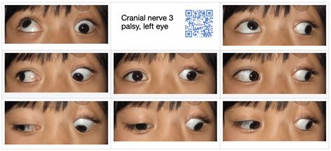 3rd Cranial Nerve Palsy