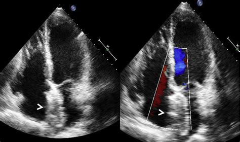 Transcatheter Closure Of Secundum Atrial Septal Defect With Large