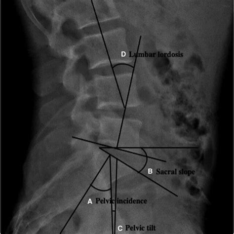 radiographic measurements of a pelvic incidence b sacral slope download scientific