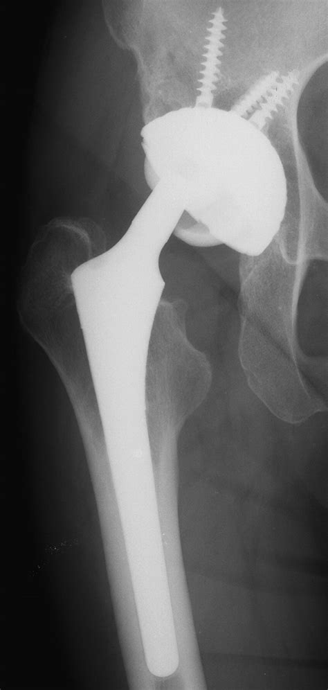 Alumina Ceramic On Ceramic Total Hip Replacement With A Layered
