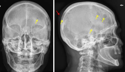 Lytic Lesions In The Skull Radiology Cases