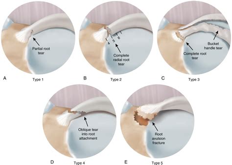 Meniscal Root Tears Musculoskeletal Key