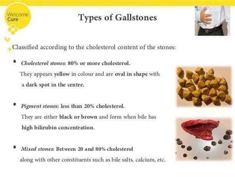Types Of Gall Stones Medizzy