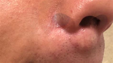 Lip Sebaceous Cyst Removal Dr Carlos A Pardo Youtube