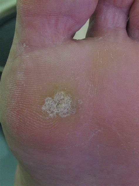 Treating Plantar Warts With Tea Tree Oil Gel Arch Supports India