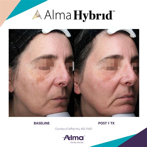 Alma Hybrid Resurfacing Laser Ageless Esthetics Medspa