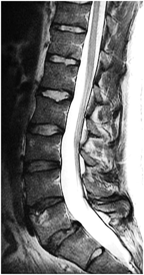 Lumbar Spine Mri Bulging Disc