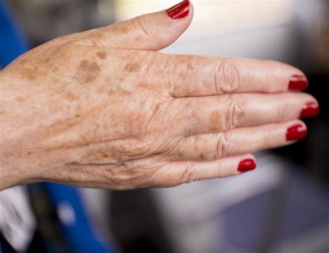 Manos De La Mujer Con Los Defectos De La Artritis Y De La Piel Del