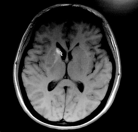 Brain Mri Scan Shows Focal Ischemic Infarcts In The Right Lentiform
