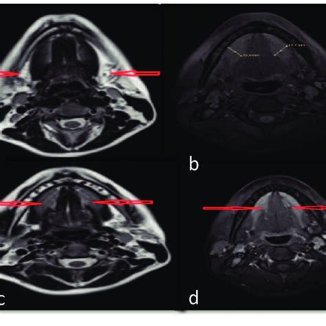 A Both Bilateral Submandibular Glands Were Not Seen In Their Normal