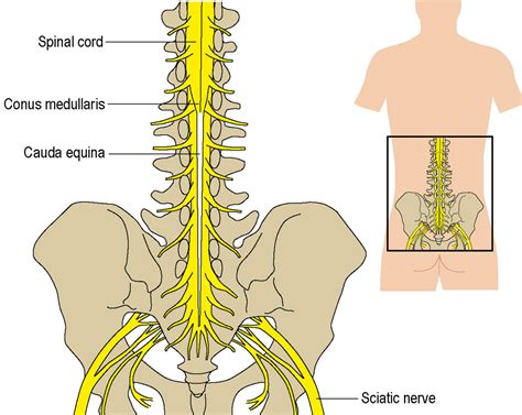 Cauda Equina Syndrome Symptoms Causes Treatment By Back Braces