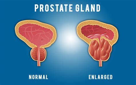 Prostate And Prostate Signs
