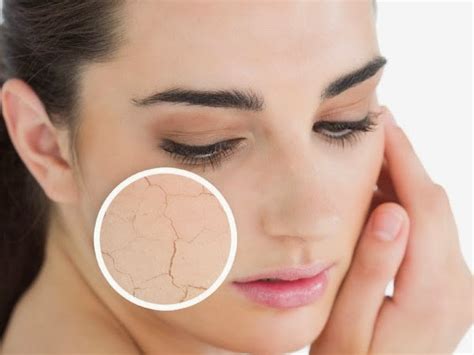 Do You Know How To Treat Dry Skin With Acne