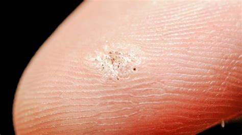 These have an appearance of black dots and are caused by the surrounding blood vessels. Seed Warts: Contagious, On Fingers, Home Remedies, On Foot