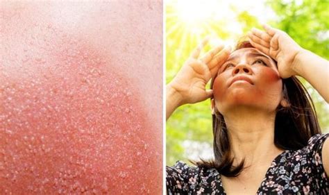 How To Avoid Prickly Heat Or Heat Rash The 5 Tips Medicine World