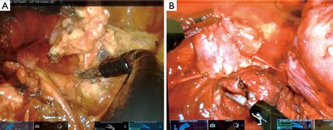 Subxiphoid Or Subcostal Uniportal Robotic Assisted Surgery Early