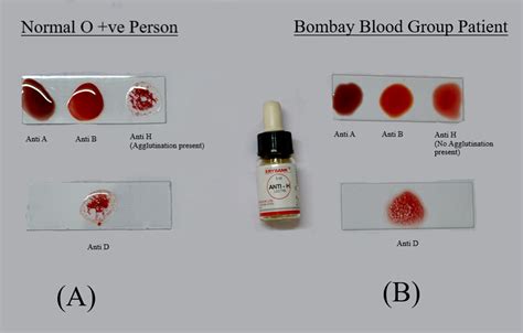 Process Of Blood Typing Blood Types Explained