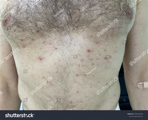 Multiple Erythematous Papule Chest Wall Abdominal Stock Photo