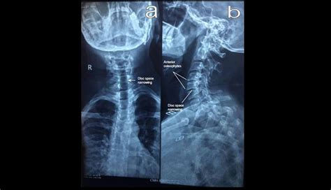 Cureus Notalgia Paresthetica Cervical Spine Disease And Neuropathic